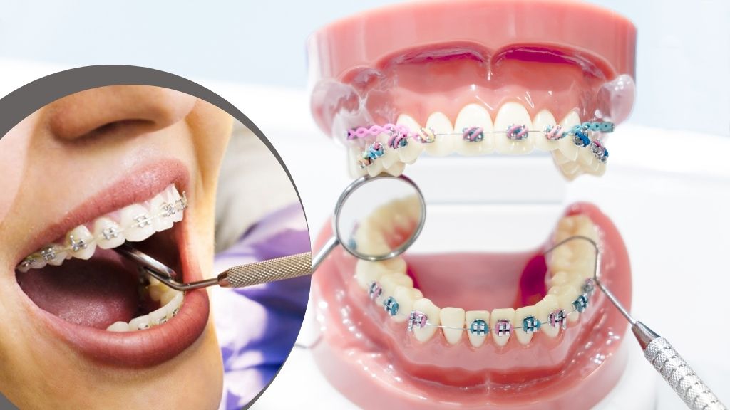 Braces for All Ages Why Adults Are Choosing Cheer Dental for Orthodontics