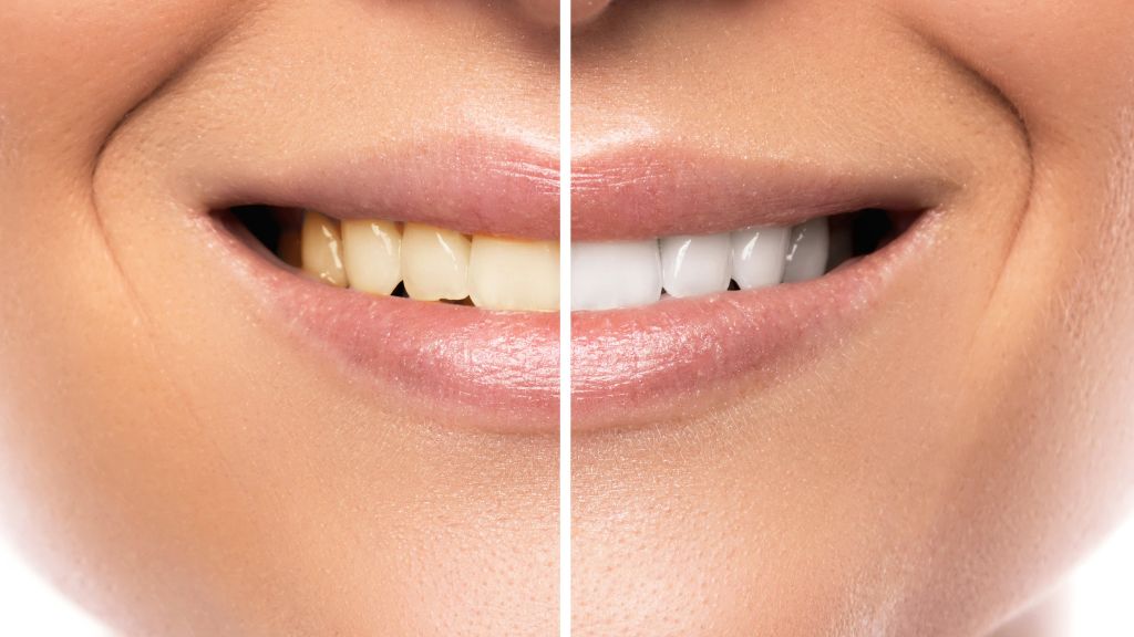 From Yellow to Wow Your Options for Teeth Whitening