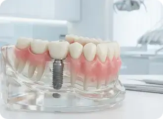 “Dental implant treatment at Cheer Dental.
